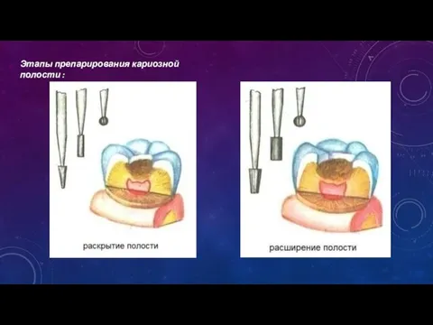 Этапы препарирования кариозной полости :