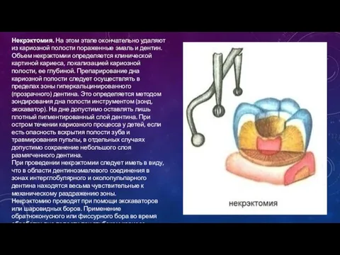 Некрэктомия. На этом этапе окончательно удаляют из кариозной полости пораженные