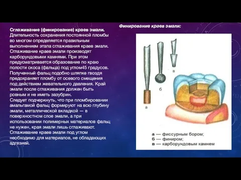 Сглаживание (финирование) краев эмали. Длительность сохранения постоянной пломбы во многом