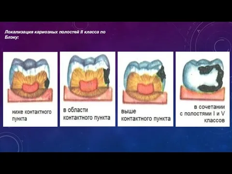 Локализация кариозных полостей II класса по Блэку: