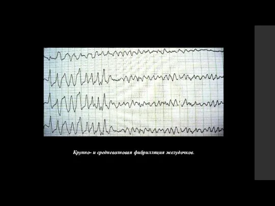 Крупно- и средневолновая фибрилляция желудочков.