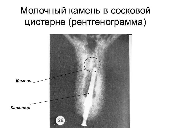 Молочный камень в сосковой цистерне (рентгенограмма) Камень Катетер
