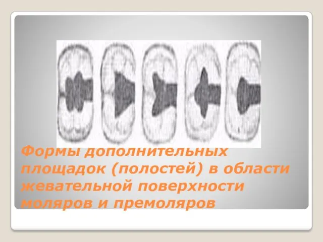 Формы дополнительных площадок (полостей) в области жевательной поверхности моляров и премоляров