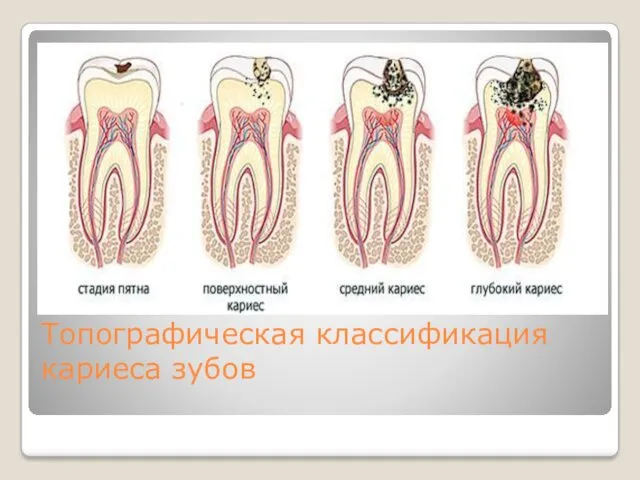 Топографическая классификация кариеса зубов