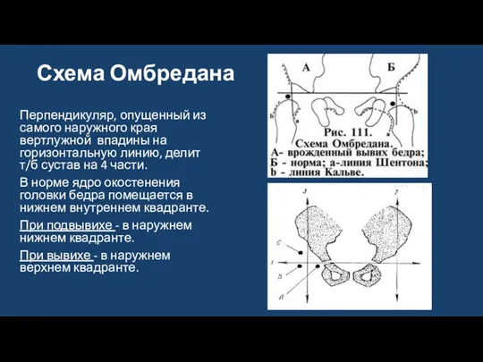 Схема Омбредана Перпендикуляр, опущенный из самого наружного края вертлужной впадины