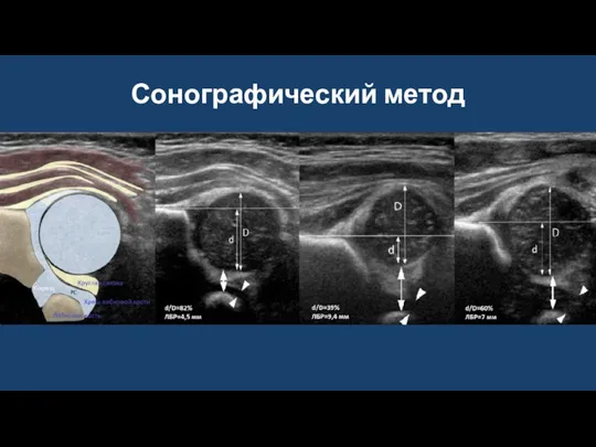 Сонографический метод