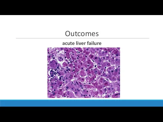 Outcomes acute liver failure