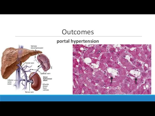 Outcomes portal hypertension