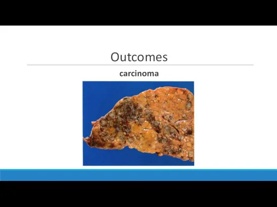 Outcomes carcinoma