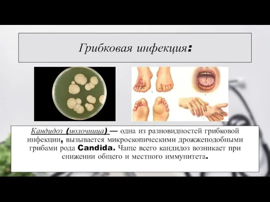 Грибковая инфекция: Кандидоз (молочница) — одна из разновидностей грибковой инфекции,