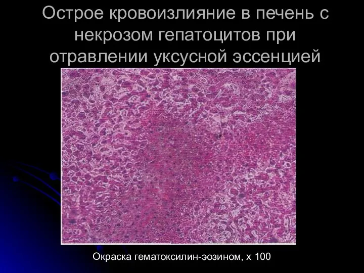 Острое кровоизлияние в печень с некрозом гепатоцитов при отравлении уксусной эссенцией Окраска гематоксилин-эозином, х 100