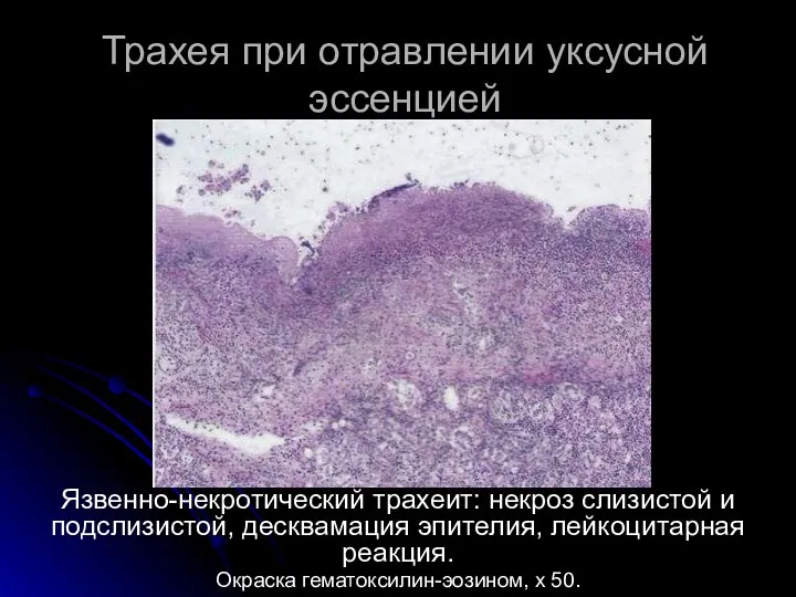 Трахея при отравлении уксусной эссенцией Язвенно-некротический трахеит: некроз слизистой и подслизистой, десквамация эпителия,
