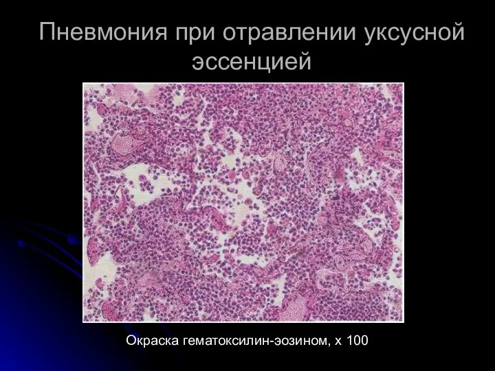 Пневмония при отравлении уксусной эссенцией Окраска гематоксилин-эозином, х 100