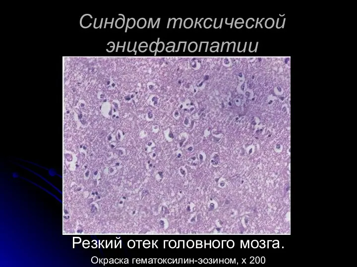 Синдром токсической энцефалопатии Резкий отек головного мозга. Окраска гематоксилин-эозином, х 200