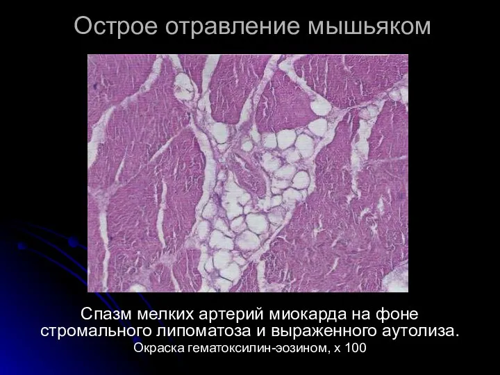 Острое отравление мышьяком Спазм мелких артерий миокарда на фоне стромального липоматоза и выраженного