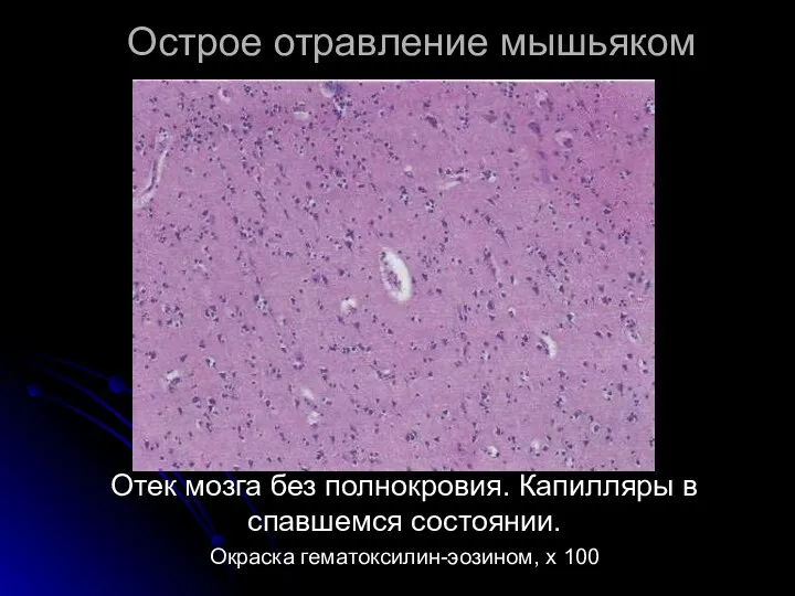 Острое отравление мышьяком Отек мозга без полнокровия. Капилляры в спавшемся состоянии. Окраска гематоксилин-эозином, х 100