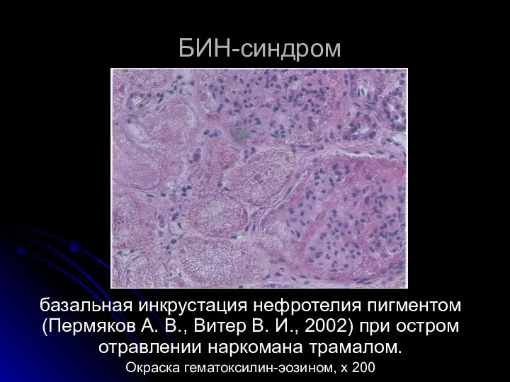 БИН-синдром базальная инкрустация нефротелия пигментом (Пермяков А. В., Витер В. И., 2002) при
