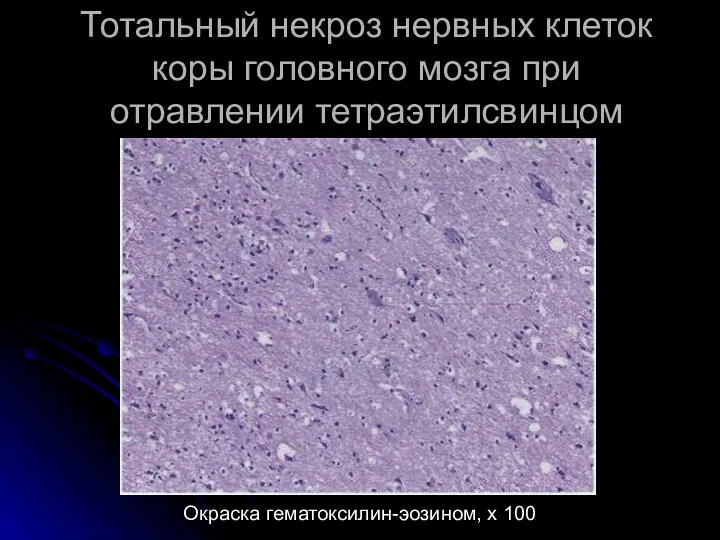Тотальный некроз нервных клеток коры головного мозга при отравлении тетраэтилсвинцом Окраска гематоксилин-эозином, х 100
