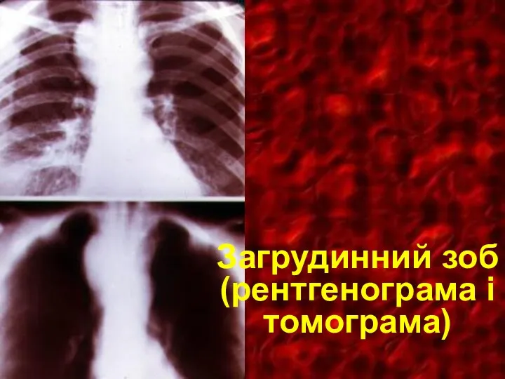 Загрудинний зоб (рентгенограма і томограма)