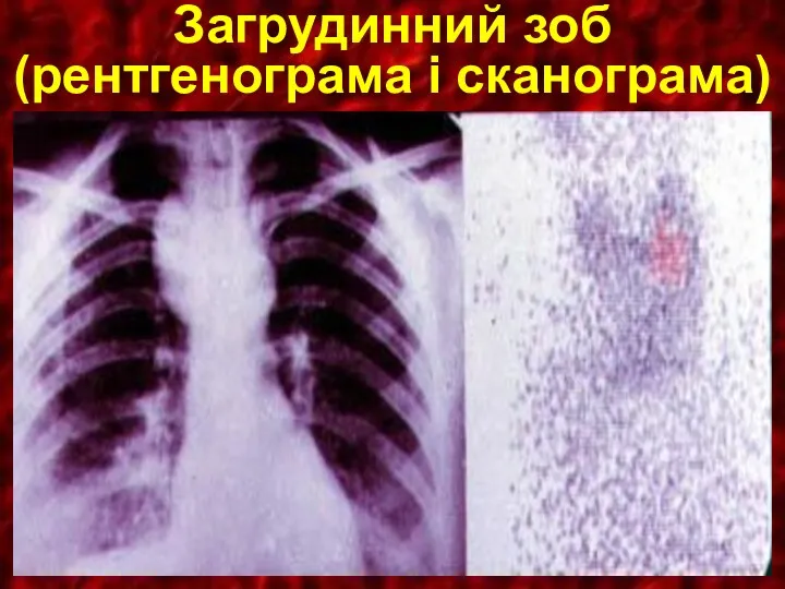 Загрудинний зоб (рентгенограма i сканограма)