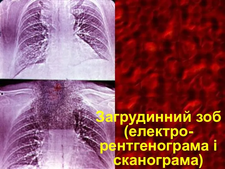 Загрудинний зоб (електро-рентгенограма i сканограма)
