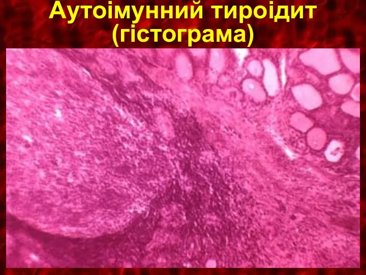 Аутоiмунний тироiдит (гiстограма)
