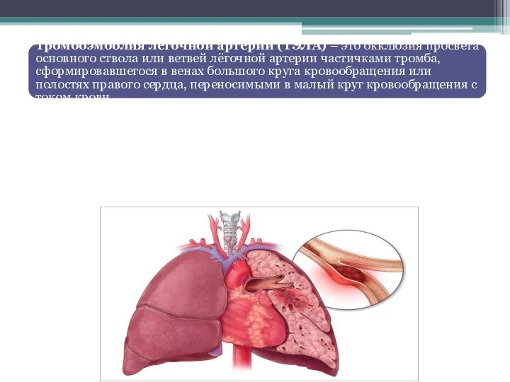 Тромбоэмболия лёгочной артерии (ТЭЛА) – это окклюзия просвета основного ствола или ветвей лёгочной