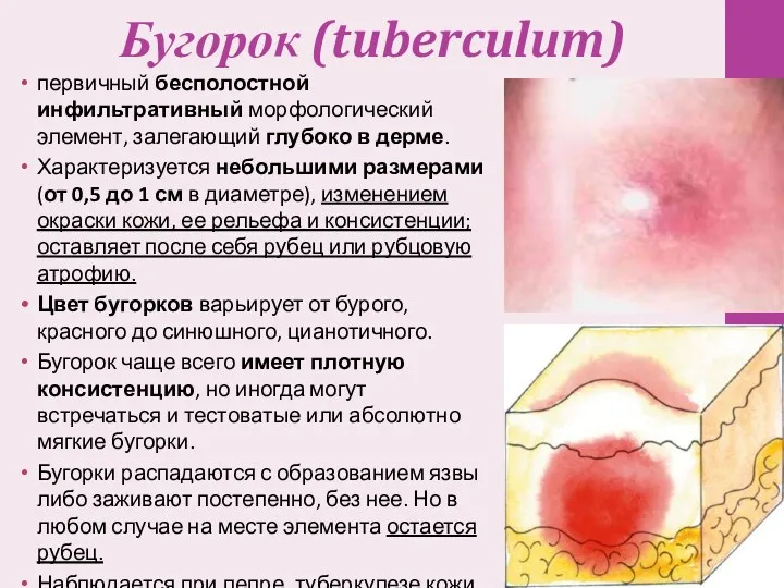 Бугорок (tuberculum) первичный бесполостной инфильтративный морфологический элемент, залегающий глубоко в дерме. Характеризуется небольшими