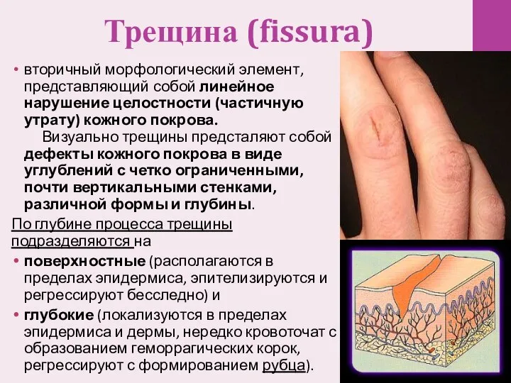 Трещина (fissura) вторичный морфологический элемент, представляющий собой линейное нарушение целостности (частичную утрату) кожного