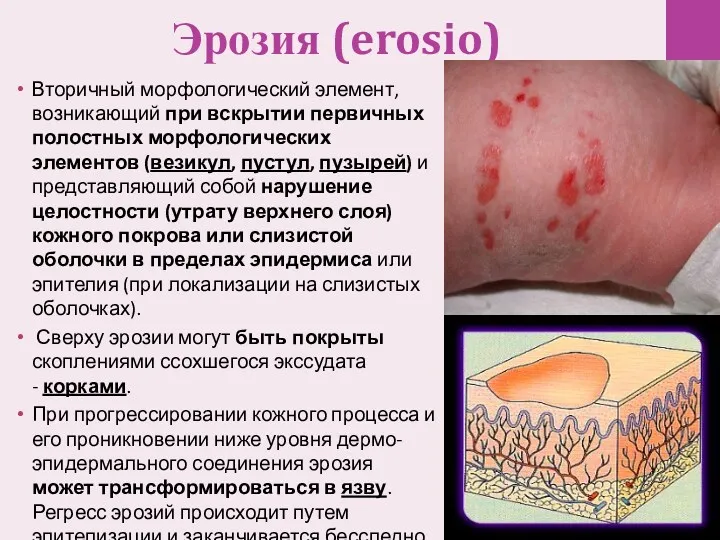 Эрозия (erosio) Вторичный морфологический элемент, возникающий при вскрытии первичных полостных морфологических элементов (везикул,