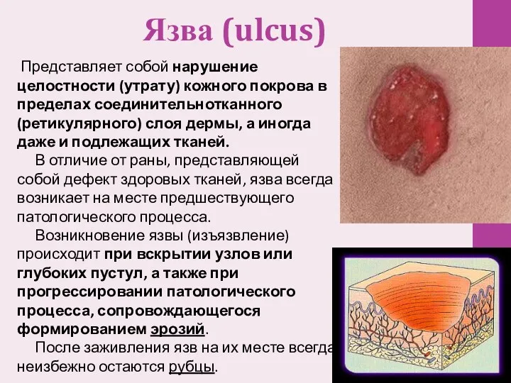 Язва (ulcus) Представляет собой нарушение целостности (утрату) кожного покрова в пределах соединительнотканного (ретикулярного)