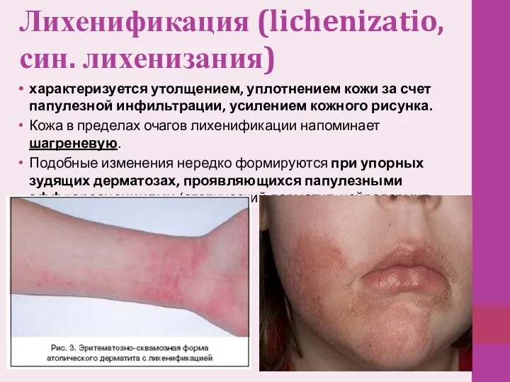 Лихенификация (lichenizatio, син. лихенизания) характеризуется утолщением, уплотнением кожи за счет папулезной инфильтрации, усилением