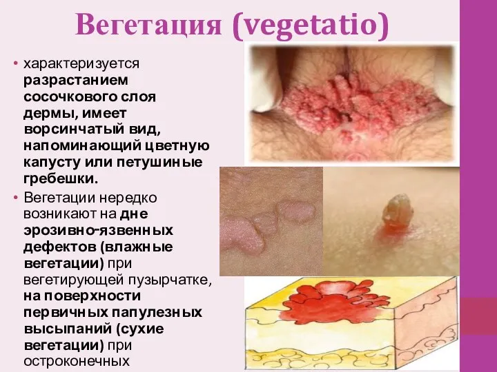 Вегетация (vegetatio) характеризуется разрастанием сосочкового слоя дермы, имеет ворсинчатый вид, напоминающий цветную капусту