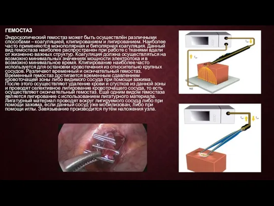 ГЕМОСТАЗ Эндоскопический гемостаз может быть осуществлён различными способами – коагуляцией,