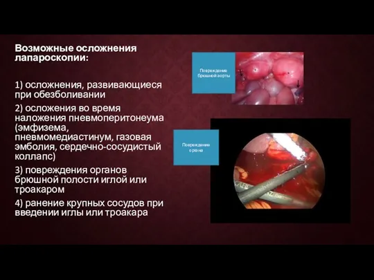 Возможные осложнения лапароскопии: 1) осложнения, развивающиеся при обезболивании 2) осложения