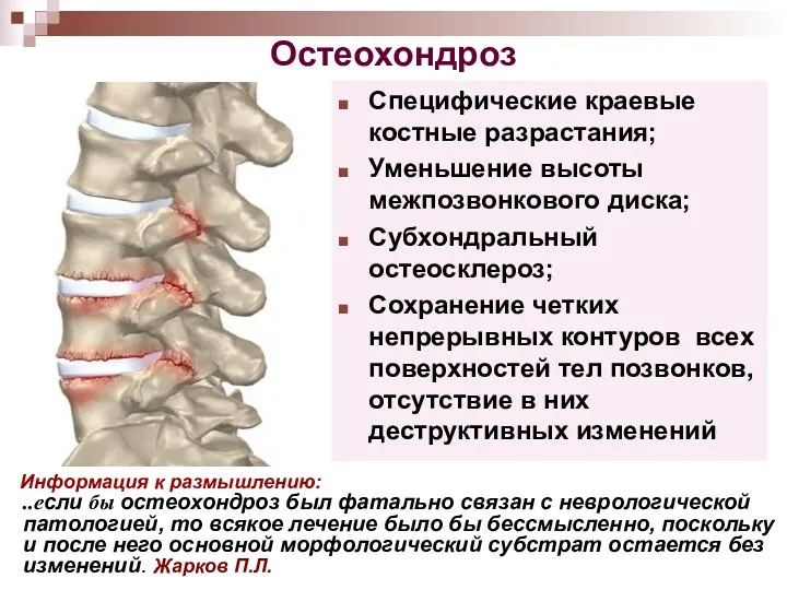 Остеохондроз Специфические краевые костные разрастания; Уменьшение высоты межпозвонкового диска; Субхондральный остеосклероз; Сохранение четких