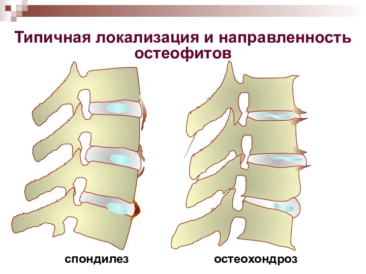 Типичная локализация и направленность остеофитов спондилез остеохондроз