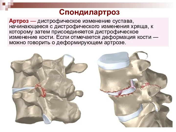 Спондилартроз Артроз — дистрофическое изменение сустава, начинающееся с дистрофического изменения хряща, к которому