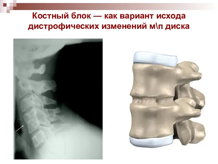 Костный блок — как вариант исхода дистрофических изменений м\п диска