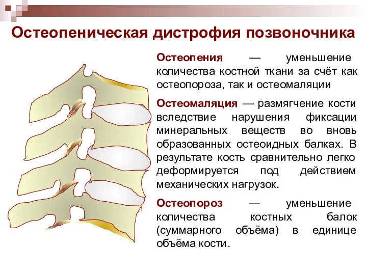 Остеопеническая дистрофия позвоночника Остеопения — уменьшение количества костной ткани за счёт как остеопороза,