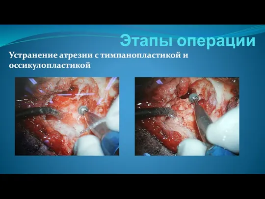 Этапы операции Устранение атрезии с тимпанопластикой и оссикулопластикой