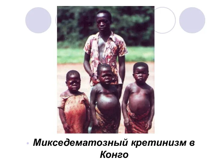 Микседематозный кретинизм в Конго