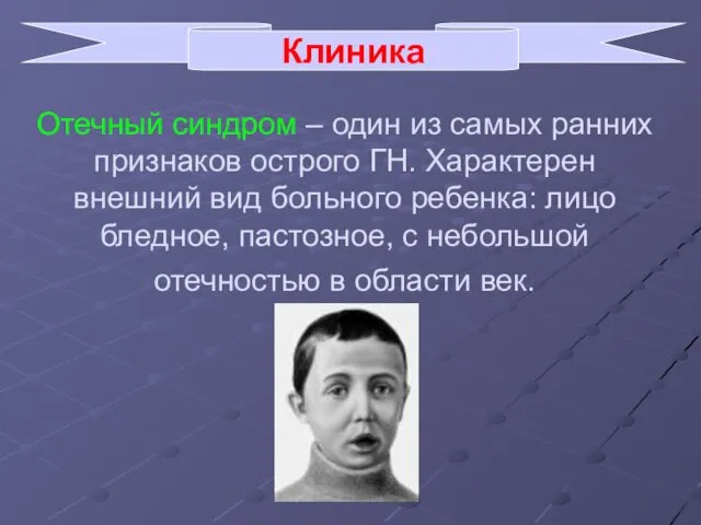 Отечный синдром – один из самых ранних признаков острого ГН.