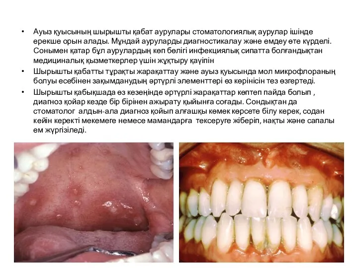 Ауыз қуысының шырышты қабат аурулары стоматологиялық аурулар ішінде ерекше орын