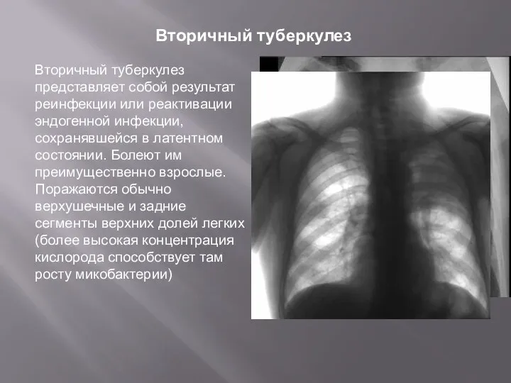 Вторичный туберкулез Вторичный туберкулез представляет собой результат реинфекции или реактивации