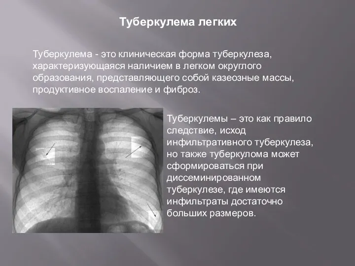 Туберкулема легких Туберкулема - это клиническая форма туберкулеза, характеризующаяся наличием в легком округлого