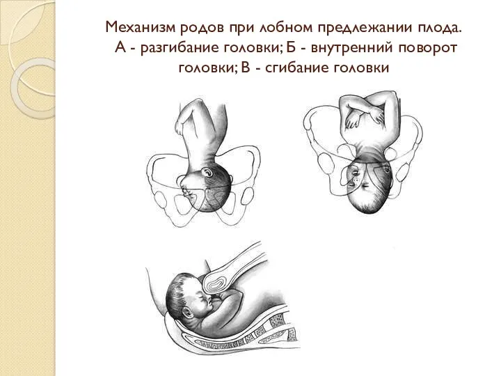 Механизм родов при лобном предлежании плода. А - разгибание головки;