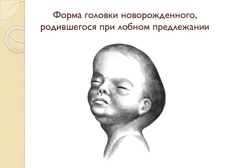 Форма головки новорожденного, родившегося при лобном предлежании