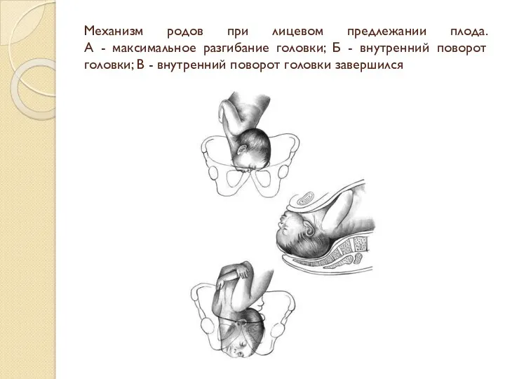 Механизм родов при лицевом предлежании плода. А - максимальное разгибание