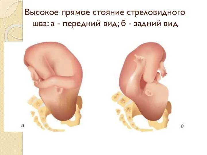 Высокое прямое стояние стреловидного шва: а - передний вид; б - задний вид